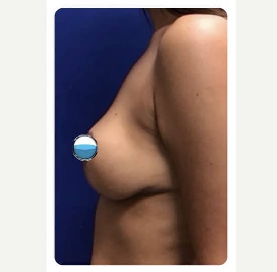 After Image: Breast Explant Surgery and Lift: 1 Month Post Op - left-side