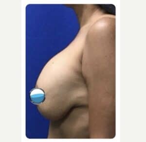 Before Image: Breast Explant Surgery and Lift: 1 Month Post Op