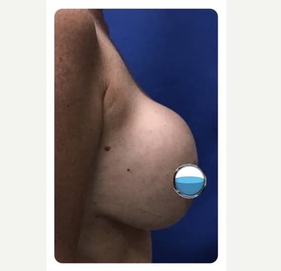 Before Image: Breast Explant Surgery and Lift: 1 Year Post Op -