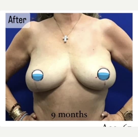 After Image: Breast Explant Surgery and Lift: 9 Months Post Op - front