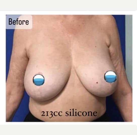 Before Image: Breast Explant Surgery and Lift: 9 Months Post Op - front
