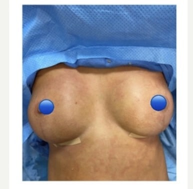 After Image: Breast Explant Surgery with Lift + Fat Transfer - front