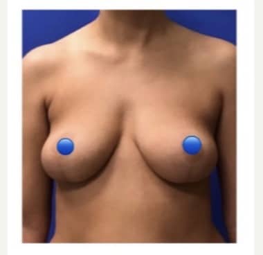 Before Image: Breast Explant Surgery with Lift + Fat Transfer - front