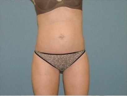 After Image: Liposuction - front