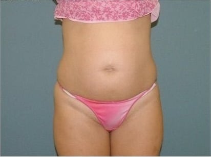 Before Image: Liposuction - front