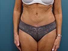 After Image: Tummy Tuck - front