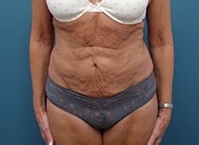 Before Image: Tummy Tuck - front