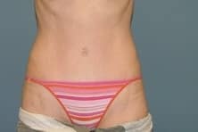After Image: Tummy Tuck - front