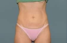 Before Image: Tummy Tuck - front