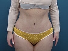 After Image: Tummy Tuck and Liposuction (Hips) - front