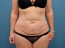 Before Image: Tummy Tuck and Liposuction (Hips) - front