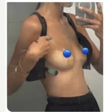 After Image: Breast Explant Surgery and Lift: 6 DAYS Post Op - left-side