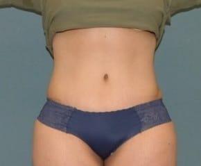 After Image: Tummy Tuck and Liposuction (Hips) - front