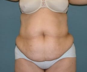 Before Image: Tummy Tuck and Liposuction (Hips) - front