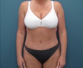 After Image: Tummy Tuck and Liposuction (Hips) - front