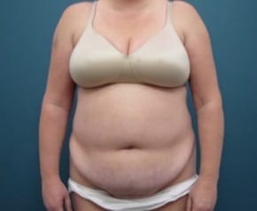 Before Image: Tummy Tuck and Liposuction (Hips) - front