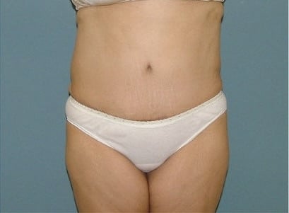 After Image: Tummy Tuck - front