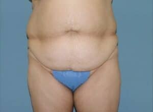 Before Image: Tummy Tuck
