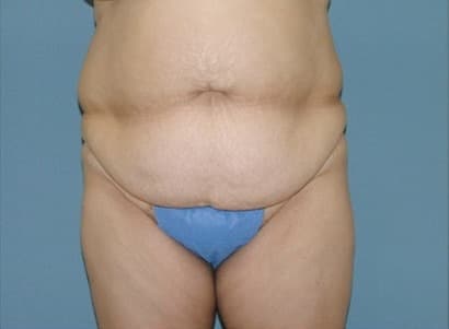 Before Image: Tummy Tuck - front