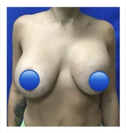 Before Image: Breast Explant and Breast Lift: 1 Month Post Op - front