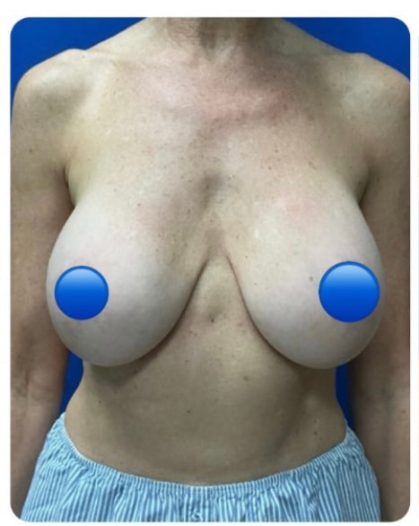 Before Image: Breast Explant Surgery and Lift: 1 Month Post Op - front