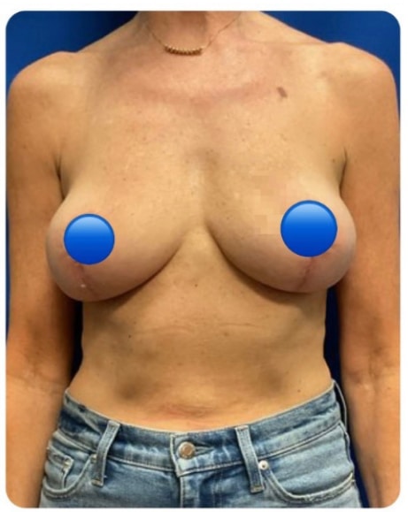 After Image: Breast Explant Surgery and Lift: 1 Month Post Op - front