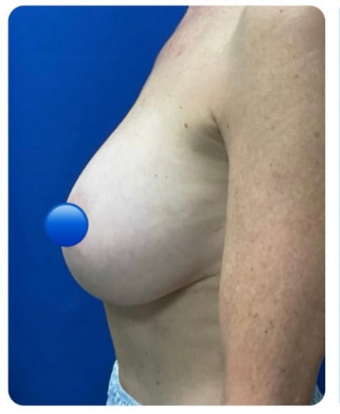 Before Image: Breast Explant Surgery and Lift: 1 Month Post Op - left-side