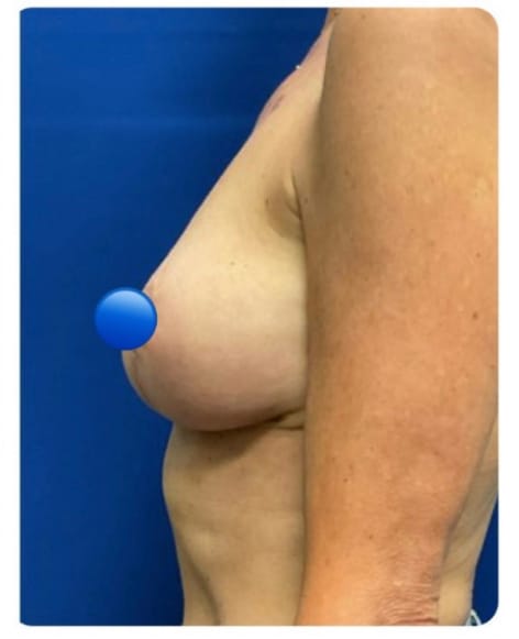 After Image: Breast Explant Surgery and Lift: 1 Month Post Op - left-side