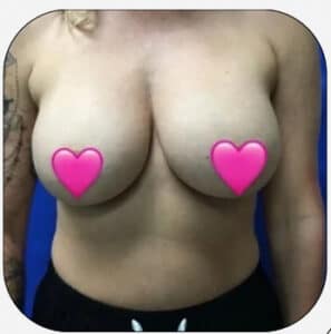 Before Image: Fat Transfer to the Breasts