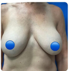 Before Image: Breast Explant and Lift: 2 Months Post Op