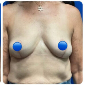 After Image: Breast Explant and Lift: 2 Months Post Op