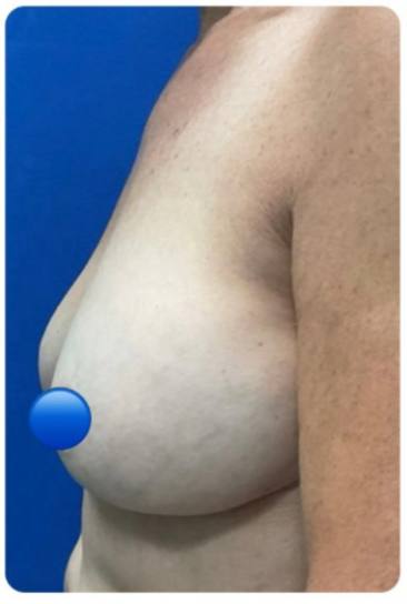 Before Image: Breast Explant and Lift: 2 Months Post Op - left-side