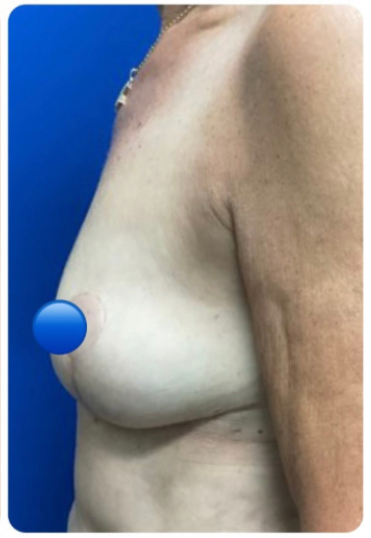 After Image: Breast Explant and Lift: 2 Months Post Op - left-side