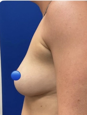 After Image: Breast Explant Surgery and Lift: 5 Months Post Op - left-side