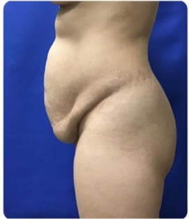 Before Image: Tummy Tuck: 6 Months Post Op - left-side
