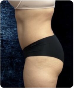 After Image: Tummy Tuck: 6 Months Post Op