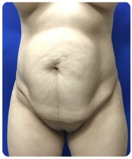 Before Image: Tummy Tuck: 6 Months Post Op - front
