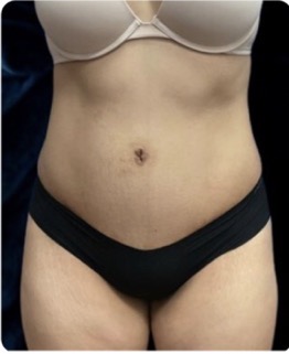 After Image: Tummy Tuck: 6 Months Post Op - front