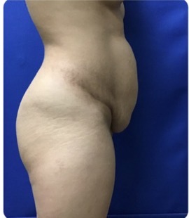 Before Image: Tummy Tuck: 6 Months Post Op - 