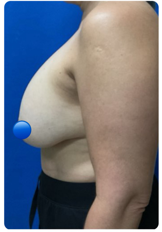 Before Image: Breast Explant Surgery and Lift: 1 Month Post Op - left-side