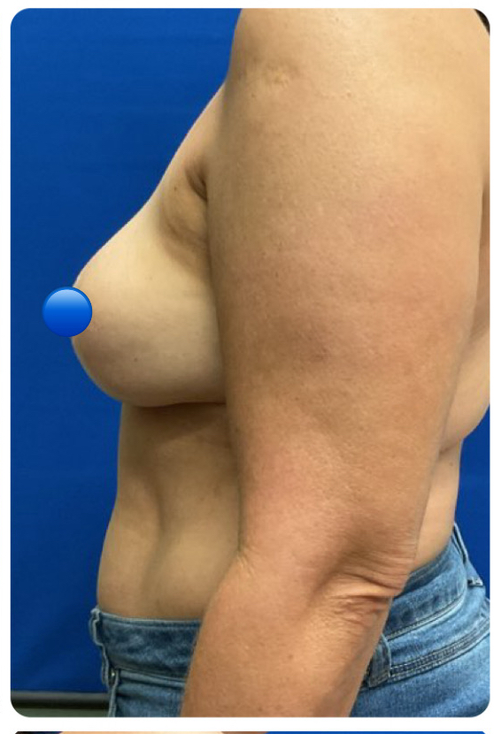 After Image: Breast Explant Surgery and Lift: 1 Month Post Op - left-side