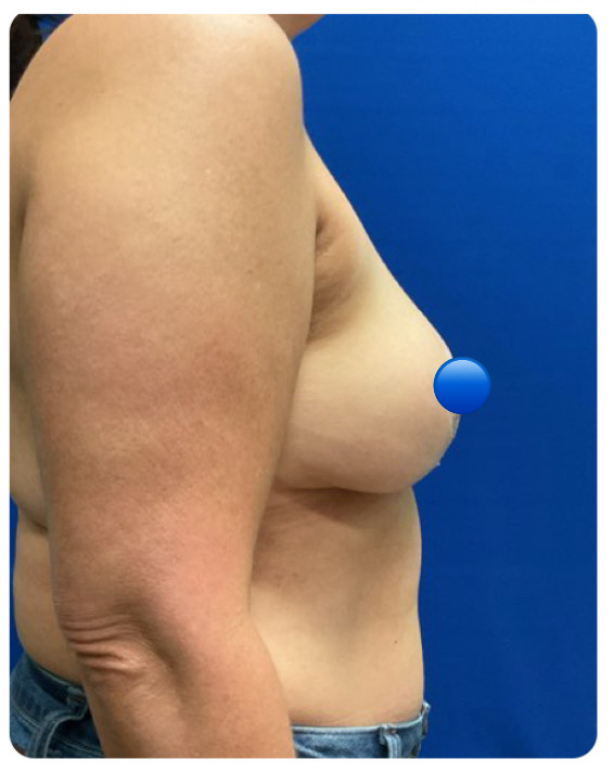 After Image: Breast Explant Surgery and Lift: 1 Month Post Op - right-side