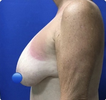 Before Image: Breast Explant Surgery and Lift: 6 Months Post Op - left-side