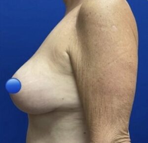 After Image: Breast Explant Surgery and Lift: 6 Months Post Op