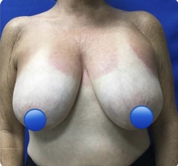 Before Image: Breast Explant Surgery and Lift: 6 Months Post Op - front