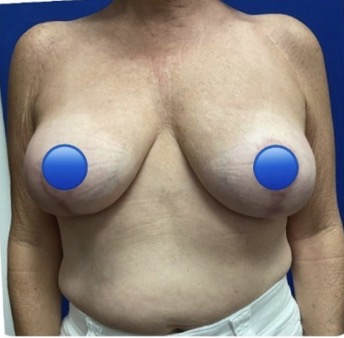 After Image: Breast Explant Surgery and Lift: 6 Months Post Op - front