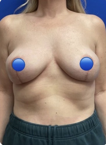 After Image: Breast Explant Surgery and Lift: 6 Weeks Post Op - 
