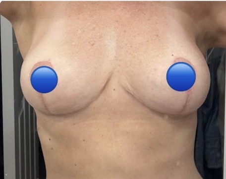After Image: Breast Explant Surgery and Lift: 6 Weeks Post Op - front