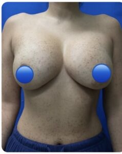 Before Image: Breast Explant Surgery and Lift: 5 Weeks Post Op