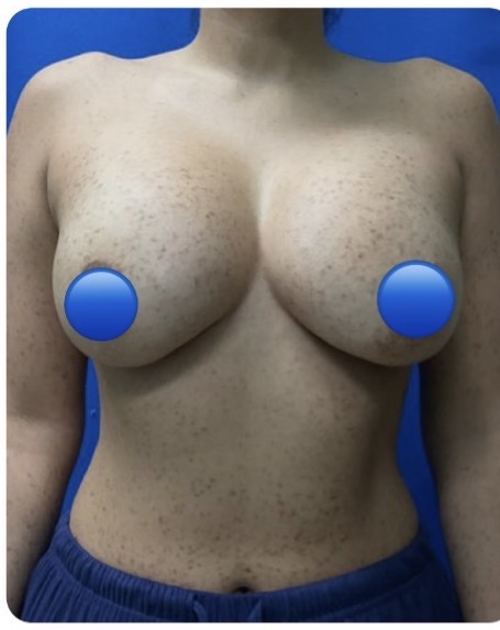 Before Image: Breast Explant Surgery and Lift: 5 Weeks Post Op - front
